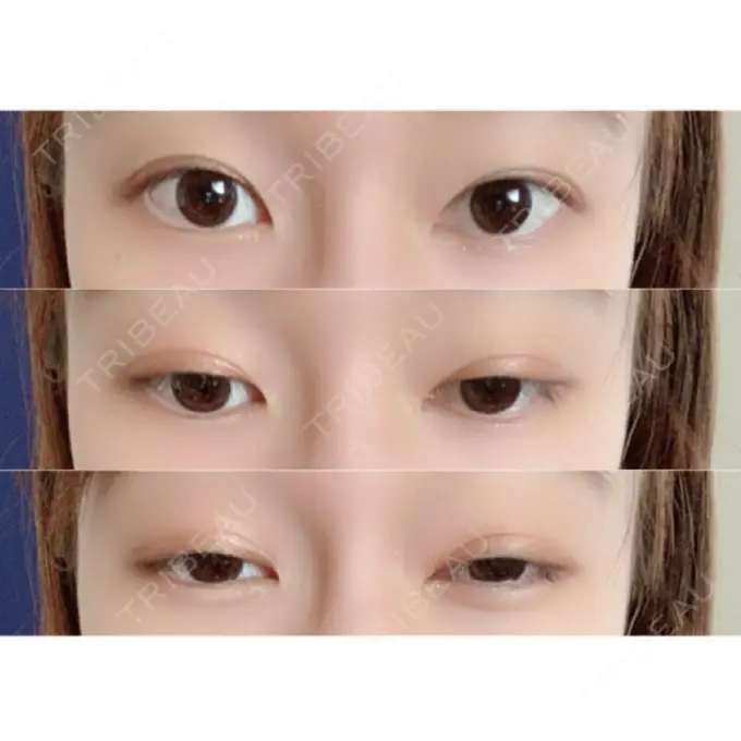 二重埋没 共立美容外科 柏院 AFTER メイン用