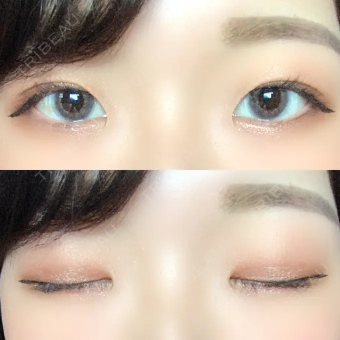 二重埋没 / 上まぶたの脂肪取り いわきタウン形成外科クリニック DAY 43 メイン用