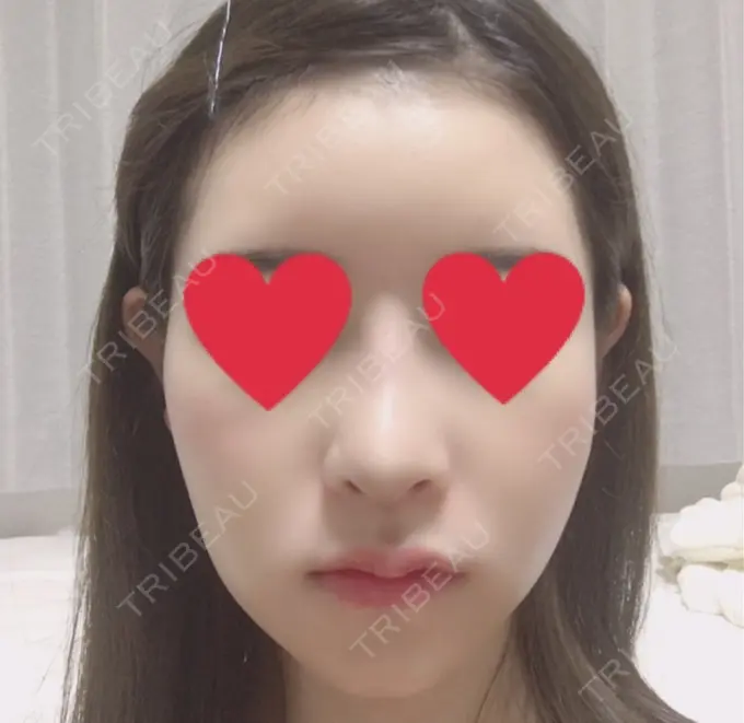 バッカルファット除去 / 脂肪吸引（顔） / ヒアルロン酸注入（あご） / レディエッセ注入（あご） / ボトックス（エラ・小顔） / その他（輪郭） エートップ美容整形外科 DAY 11 メイン用