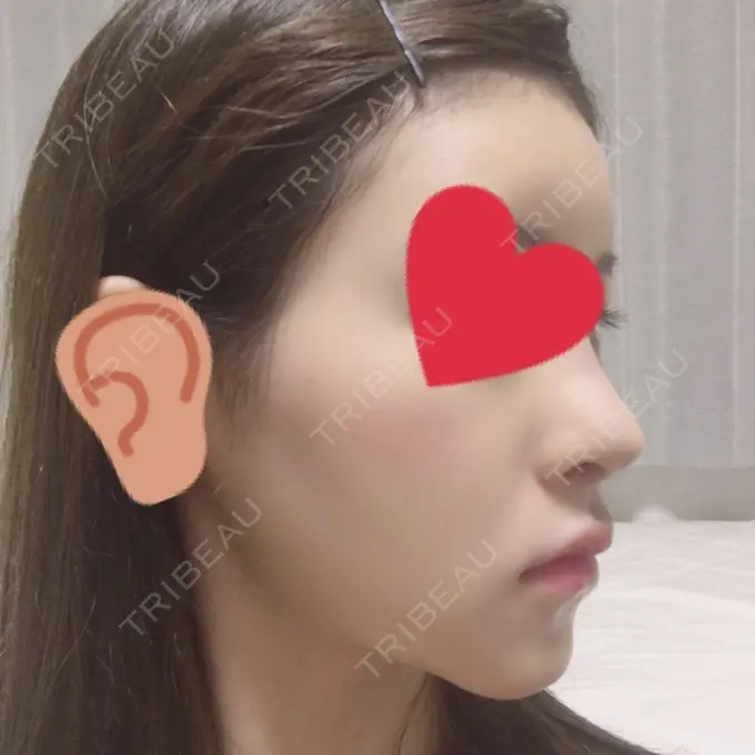 バッカルファット除去 / 脂肪吸引（顔） / ヒアルロン酸注入（あご） / レディエッセ注入（あご） / ボトックス（エラ・小顔） / その他（輪郭） エートップ美容整形外科 DAY 11 メイン用