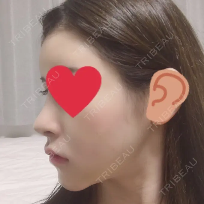 バッカルファット除去 / 脂肪吸引（顔） / ヒアルロン酸注入（あご） / レディエッセ注入（あご） / ボトックス（エラ・小顔） / その他（輪郭） エートップ美容整形外科 DAY 11 メイン用