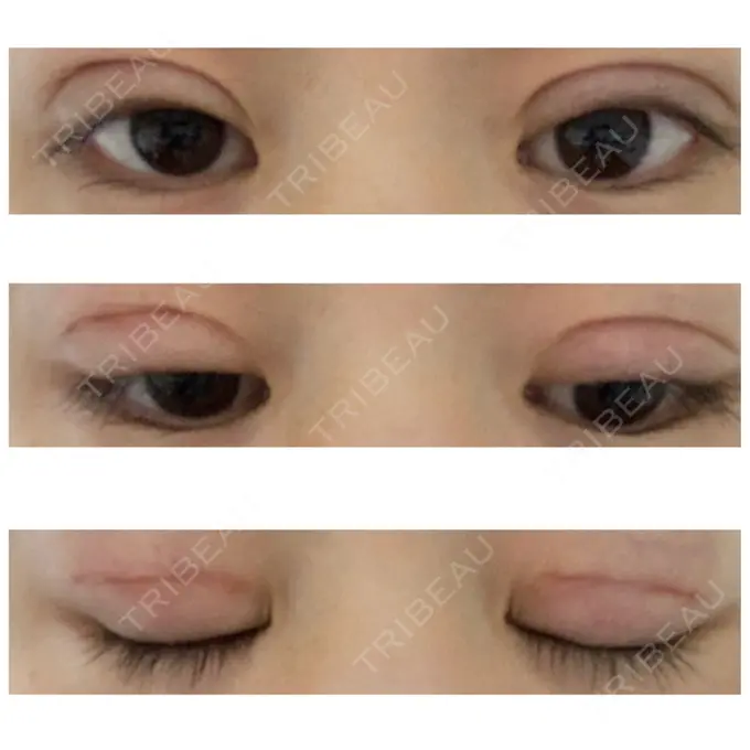 二重切開 久留米総合美容外科 DAY 43 メイン用