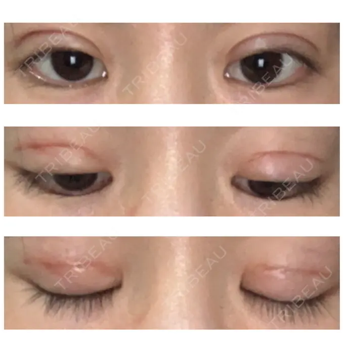 二重切開 久留米総合美容外科 DAY 49 メイン用