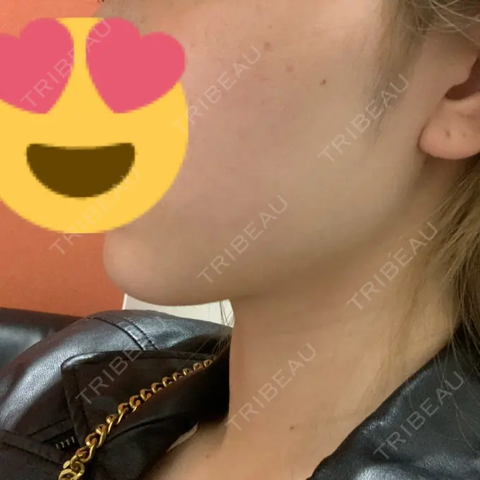 ハイフ（顔） / イオン導入 湘南美容クリニック 名古屋栄院 DAY 0 メイン用