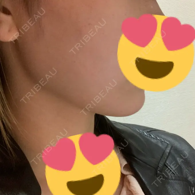 ハイフ（顔） / イオン導入 湘南美容クリニック 名古屋栄院 DAY 0 メイン用