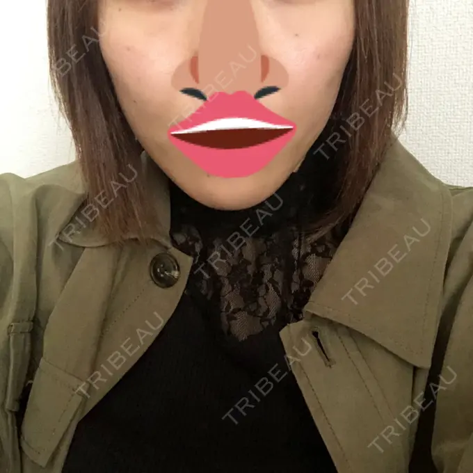 脂肪吸引（顔） アサミ美容外科 渋谷院 AFTER メイン用