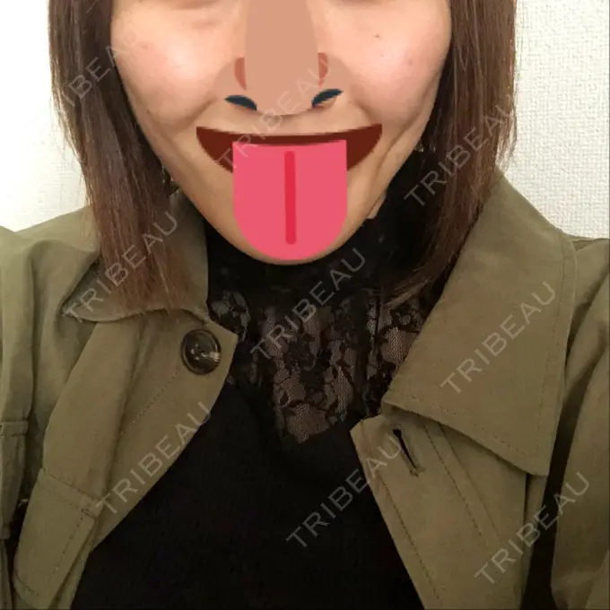 脂肪吸引（顔） アサミ美容外科 渋谷院 DAY 44 メイン用