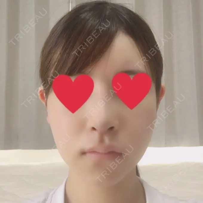 バッカルファット除去 / 脂肪吸引（顔） / ヒアルロン酸注入（あご） / レディエッセ注入（あご） / ボトックス（エラ・小顔） / その他（輪郭） エートップ美容整形外科 DAY 12 メイン用