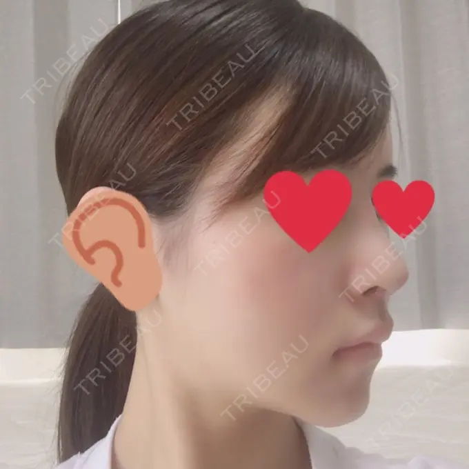 バッカルファット除去 / 脂肪吸引（顔） / ヒアルロン酸注入（あご） / レディエッセ注入（あご） / ボトックス（エラ・小顔） / その他（輪郭） エートップ美容整形外科 DAY 12 メイン用