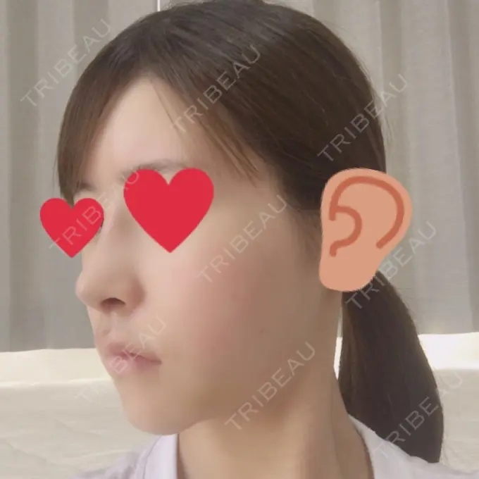 バッカルファット除去 / 脂肪吸引（顔） / ヒアルロン酸注入（あご） / レディエッセ注入（あご） / ボトックス（エラ・小顔） / その他（輪郭） エートップ美容整形外科 DAY 12 メイン用