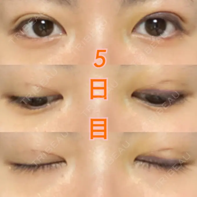 二重埋没 湘南美容クリニック 東京蒲田院 DAY 5 メイン用