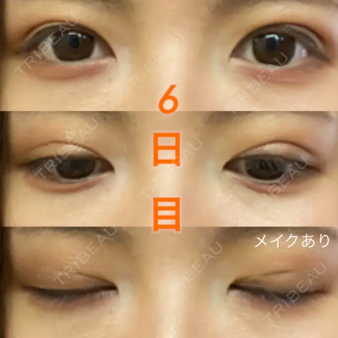 二重埋没 湘南美容クリニック 東京蒲田院 DAY 6 メイン用