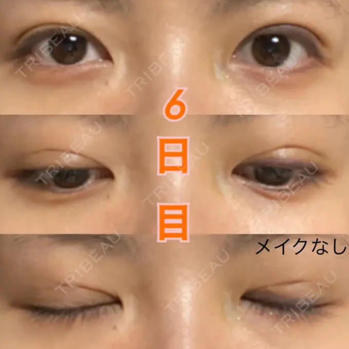 二重埋没 湘南美容クリニック 東京蒲田院 DAY 6 メイン用