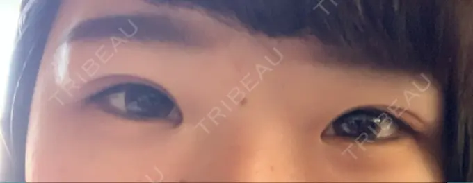 二重埋没 湘南美容クリニック 京都院 DAY 4 メイン用