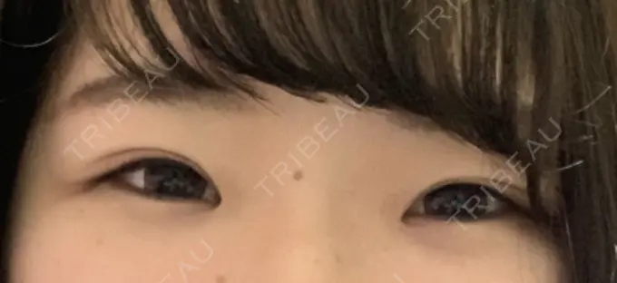 二重埋没 湘南美容クリニック 京都院 DAY 14 メイン用