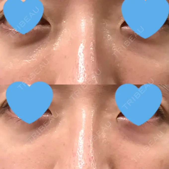 クマ治療 / 下まぶたたるみ取り / 下まぶたの脂肪取り 湘南美容クリニック 大阪あべの院 AFTER メイン用