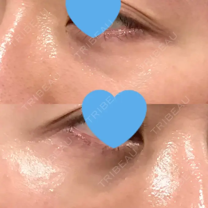 クマ治療 / 下まぶたたるみ取り / 下まぶたの脂肪取り 湘南美容クリニック 大阪あべの院 DAY 110 メイン用