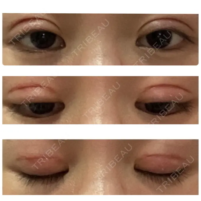 二重切開 久留米総合美容外科 DAY 51 メイン用