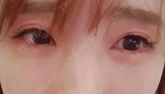 肌ヒアルロン酸注入（たるみ・シワ改善） シロアム韓方美容・ダイエットクリニック(美&EYE) DAY 0 メイン用