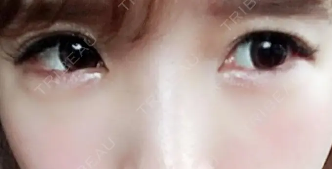 肌ヒアルロン酸注入（たるみ・シワ改善） シロアム韓方美容・ダイエットクリニック(美&EYE) AFTER メイン用