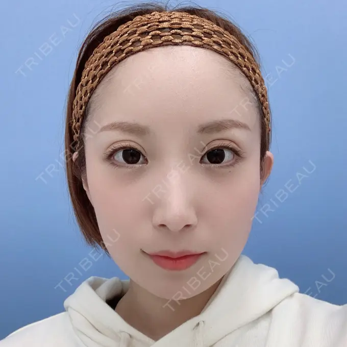 二重埋没 / 額を丸く / 下まぶたたるみ取り / 下まぶたの脂肪取り / 脂肪注入（肌） / 脂肪注入（額） / ボトックス（あご） 湘南美容クリニック 秋葉原院 DAY 37 メイン用