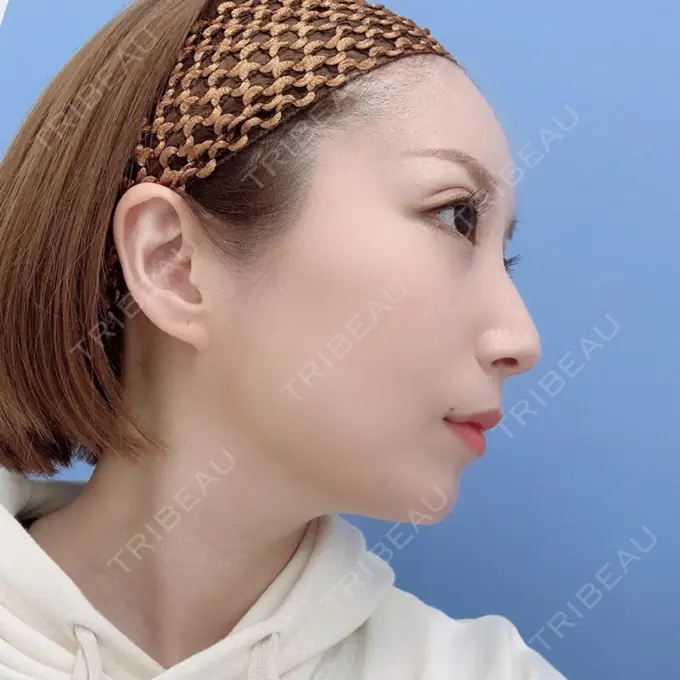 二重埋没 / 額を丸く / 下まぶたたるみ取り / 下まぶたの脂肪取り / 脂肪注入（肌） / 脂肪注入（額） / ボトックス（あご） 湘南美容クリニック 秋葉原院 DAY 37 メイン用