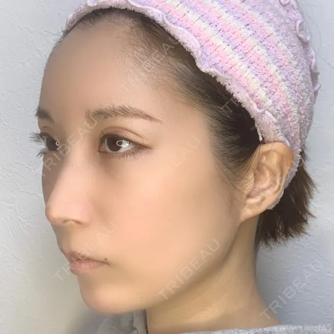 二重埋没 / 額を丸く / 下まぶたたるみ取り / 下まぶたの脂肪取り / 脂肪注入（肌） / 脂肪注入（額） / ボトックス（あご） 湘南美容クリニック 秋葉原院 DAY 17 メイン用