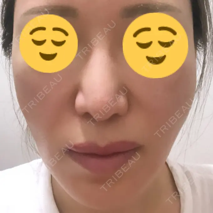 その他（目元） スノウ（Snow）整形外科 DAY 69 メイン用