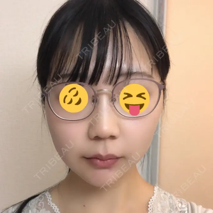 糸リフト / ボトックス（エラ・小顔） / ヒアルロン酸注入（唇） ルラ美容クリニック 高田馬場院 DAY 36 メイン用