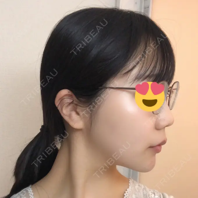 糸リフト / ボトックス（エラ・小顔） / ヒアルロン酸注入（唇） ルラ美容クリニック 高田馬場院 DAY 36 メイン用