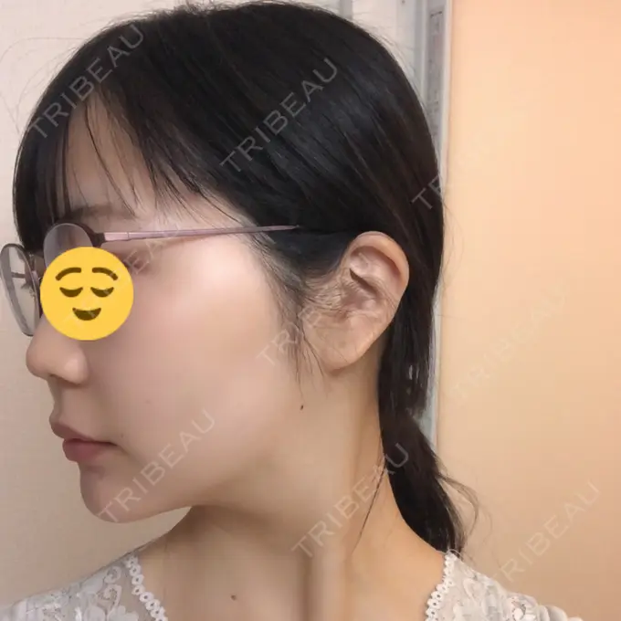 糸リフト / ボトックス（エラ・小顔） / ヒアルロン酸注入（唇） ルラ美容クリニック 高田馬場院 DAY 36 メイン用