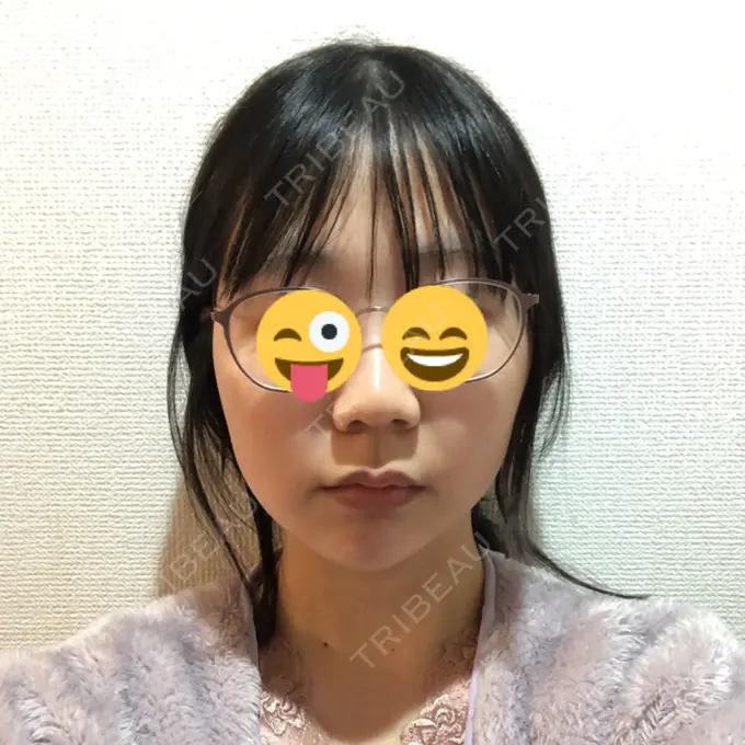 糸リフト / ボトックス（エラ・小顔） / ヒアルロン酸注入（唇） ルラ美容クリニック 高田馬場院 DAY 38 メイン用