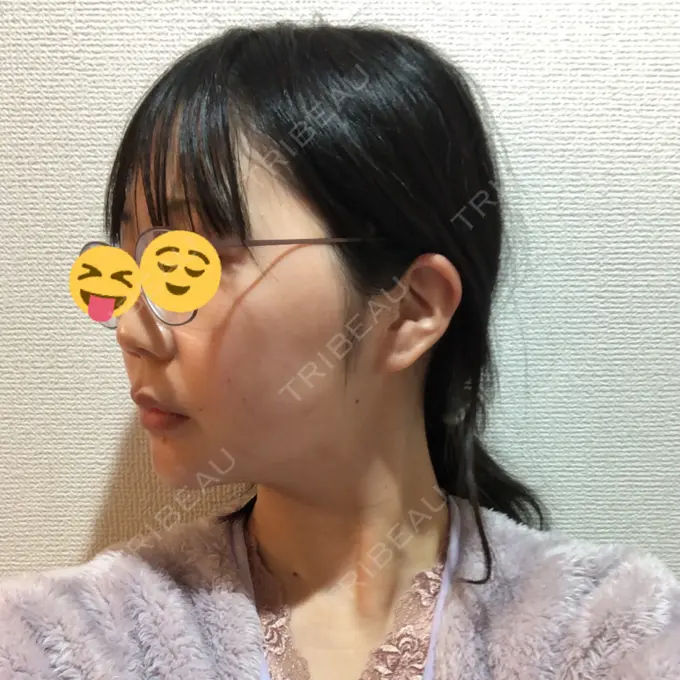 糸リフト / ボトックス（エラ・小顔） / ヒアルロン酸注入（唇） ルラ美容クリニック 高田馬場院 DAY 38 メイン用