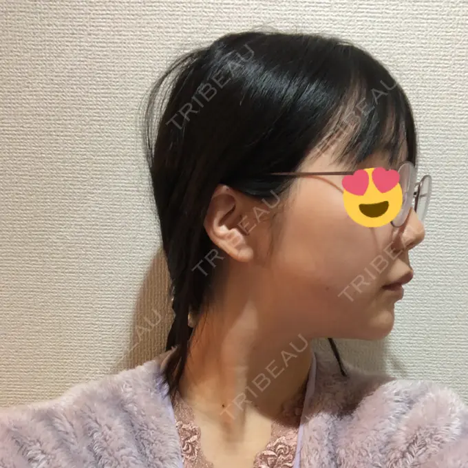 糸リフト / ボトックス（エラ・小顔） / ヒアルロン酸注入（唇） ルラ美容クリニック 高田馬場院 DAY 38 メイン用