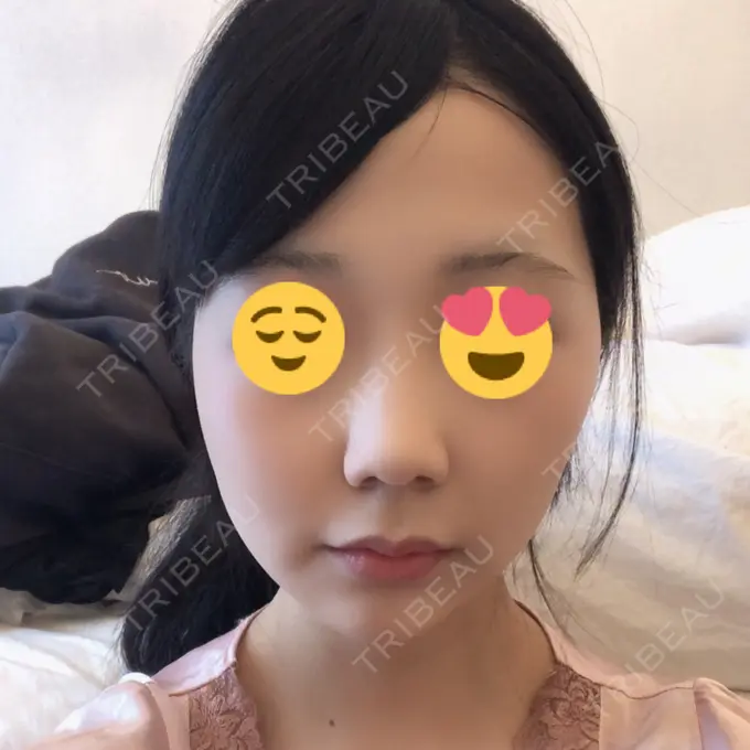 糸リフト / ボトックス（エラ・小顔） / ヒアルロン酸注入（唇） ルラ美容クリニック 高田馬場院 AFTER メイン用