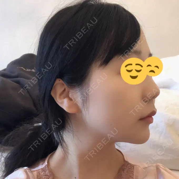 糸リフト / ボトックス（エラ・小顔） / ヒアルロン酸注入（唇） ルラ美容クリニック 高田馬場院 DAY 52 メイン用