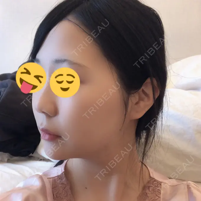 糸リフト / ボトックス（エラ・小顔） / ヒアルロン酸注入（唇） ルラ美容クリニック 高田馬場院 DAY 52 メイン用