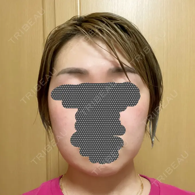 ボトックス（エラ・小顔） / 脂肪溶解注射（顔） チョンダムジュエンクリニック AFTER メイン用