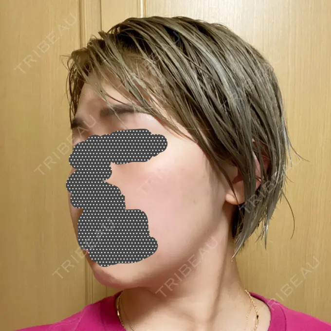 ボトックス（エラ・小顔） / 脂肪溶解注射（顔） チョンダムジュエンクリニック DAY 125 メイン用