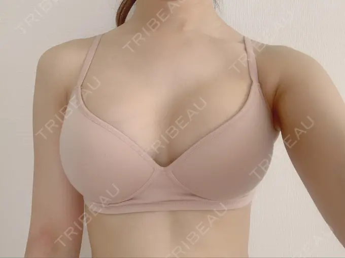 豊胸（シリコンバッグ） ウォンジン（Wonjin）整形外科 DAY 88 メイン用