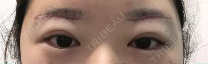 上まぶたの脂肪取り / 眉下切開 湘南美容クリニック 秋葉原院 DAY 0 メイン用