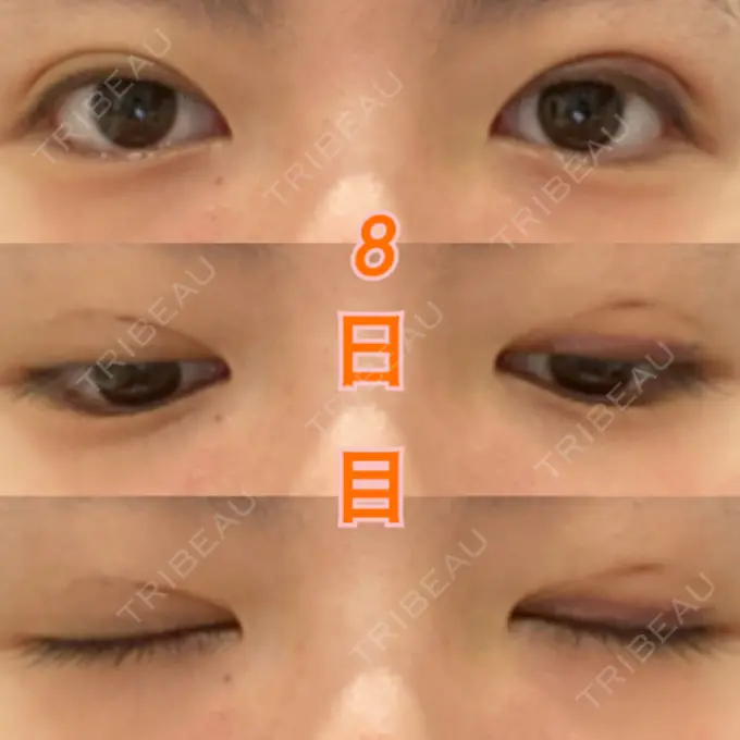 二重埋没 湘南美容クリニック 東京蒲田院 DAY 8 メイン用