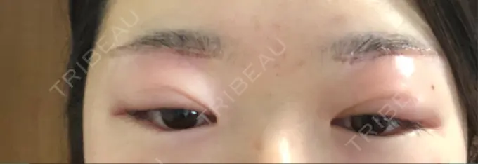 上まぶたの脂肪取り / 眉下切開 湘南美容クリニック 秋葉原院 DAY 1 メイン用