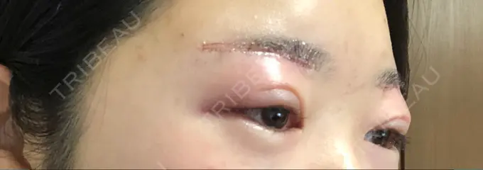 上まぶたの脂肪取り / 眉下切開 湘南美容クリニック 秋葉原院 DAY 1 メイン用