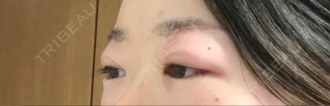 上まぶたの脂肪取り / 眉下切開 湘南美容クリニック 秋葉原院 DAY 1 メイン用