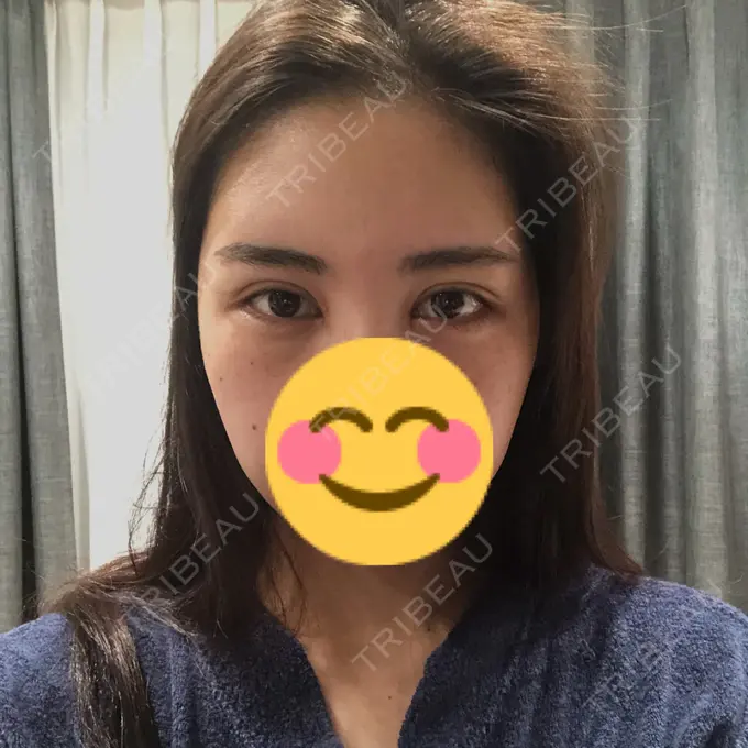 二重切開 / 目頭切開 / クマ治療 / バッカルファット除去 / 脂肪吸引（顔） / 額を丸く / 目尻切開 ヴェリテクリニック 名古屋院 DAY 17 メイン用