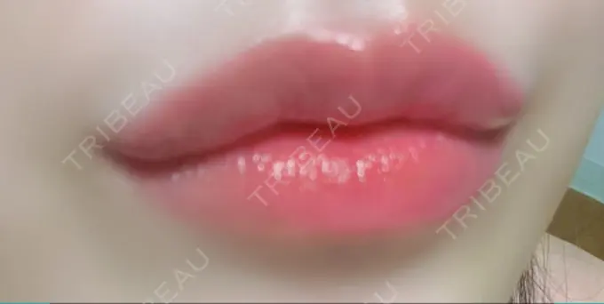 ヒアルロン酸注入（唇） ルラ美容クリニック 高田馬場院 DAY 5 メイン用