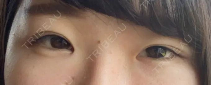 二重埋没 湘南美容クリニック 京都院 DAY 48 メイン用