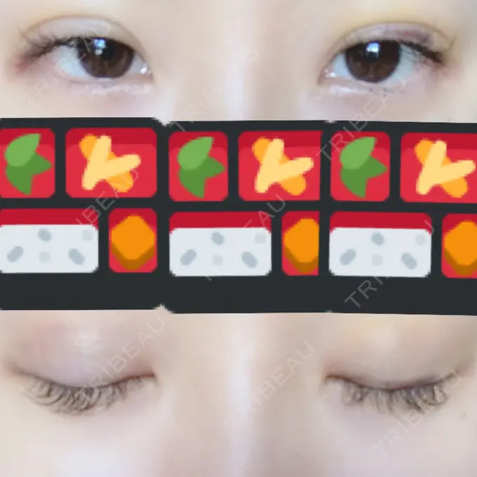 二重埋没 湘南美容クリニック 東京蒲田院 DAY 5 メイン用