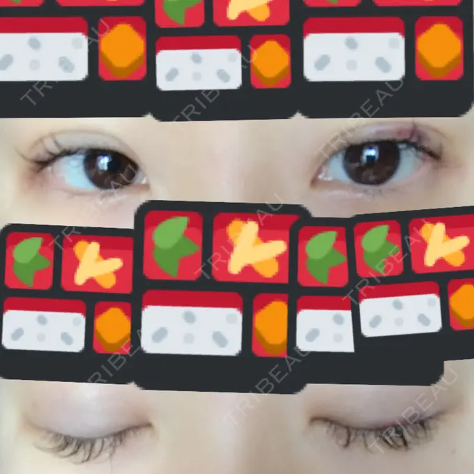 二重埋没 湘南美容クリニック 東京蒲田院 DAY 8 メイン用